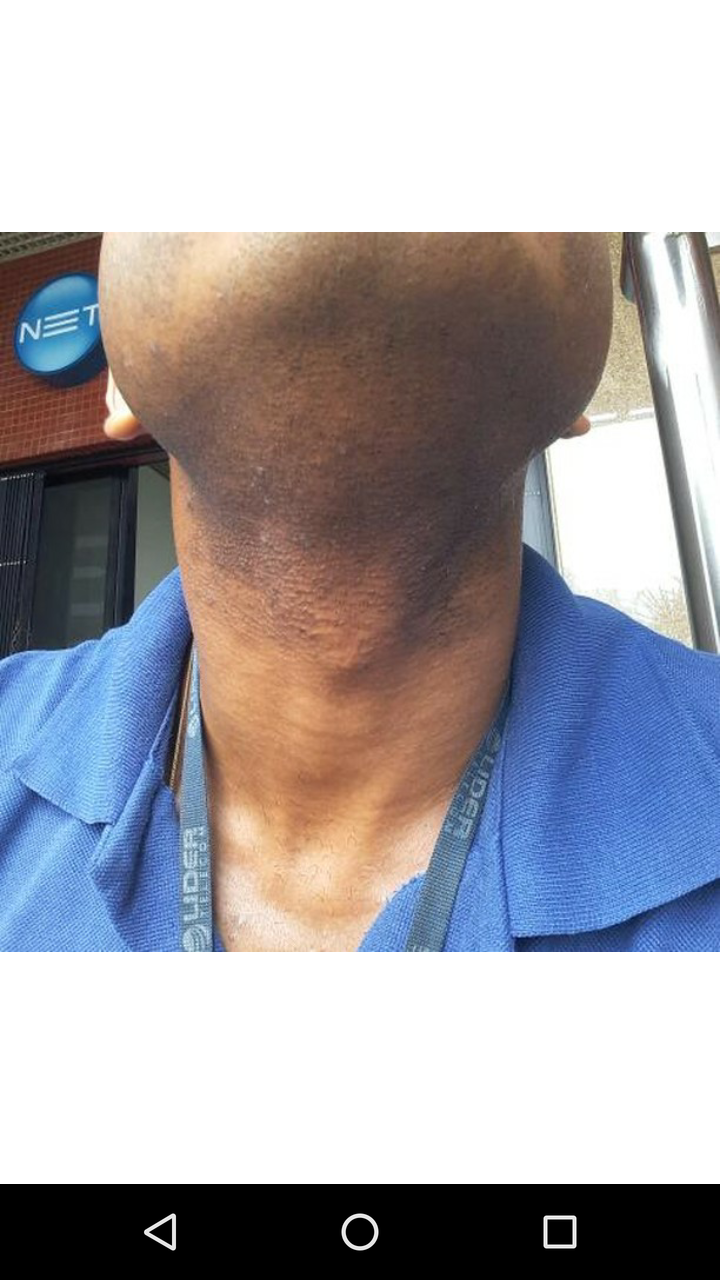 Foliculite queloidiana no pescoço antes do Tend Skin — pústulas e inflamação na nuca